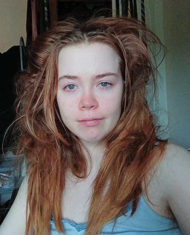 A young woman in her 20s has messy hair, after not being able to wash it for a long time due to chronic illness.